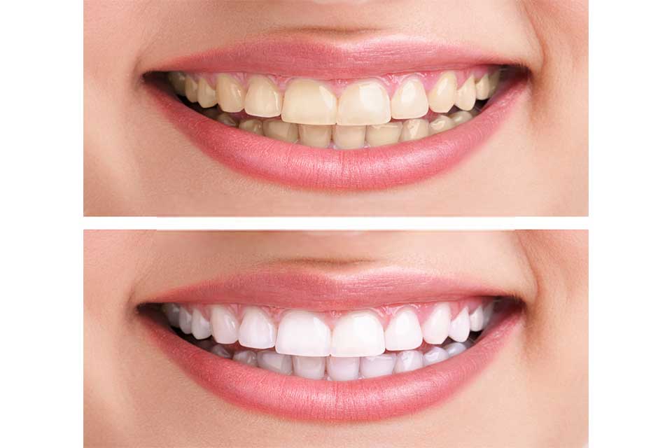teeth whitening