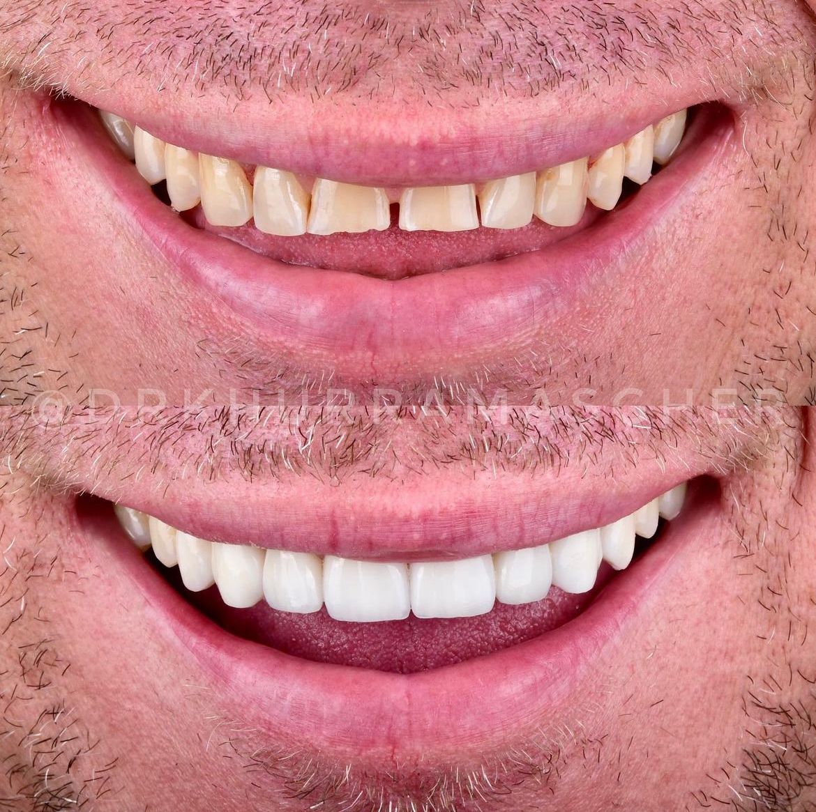PORCELAIN VENEERS